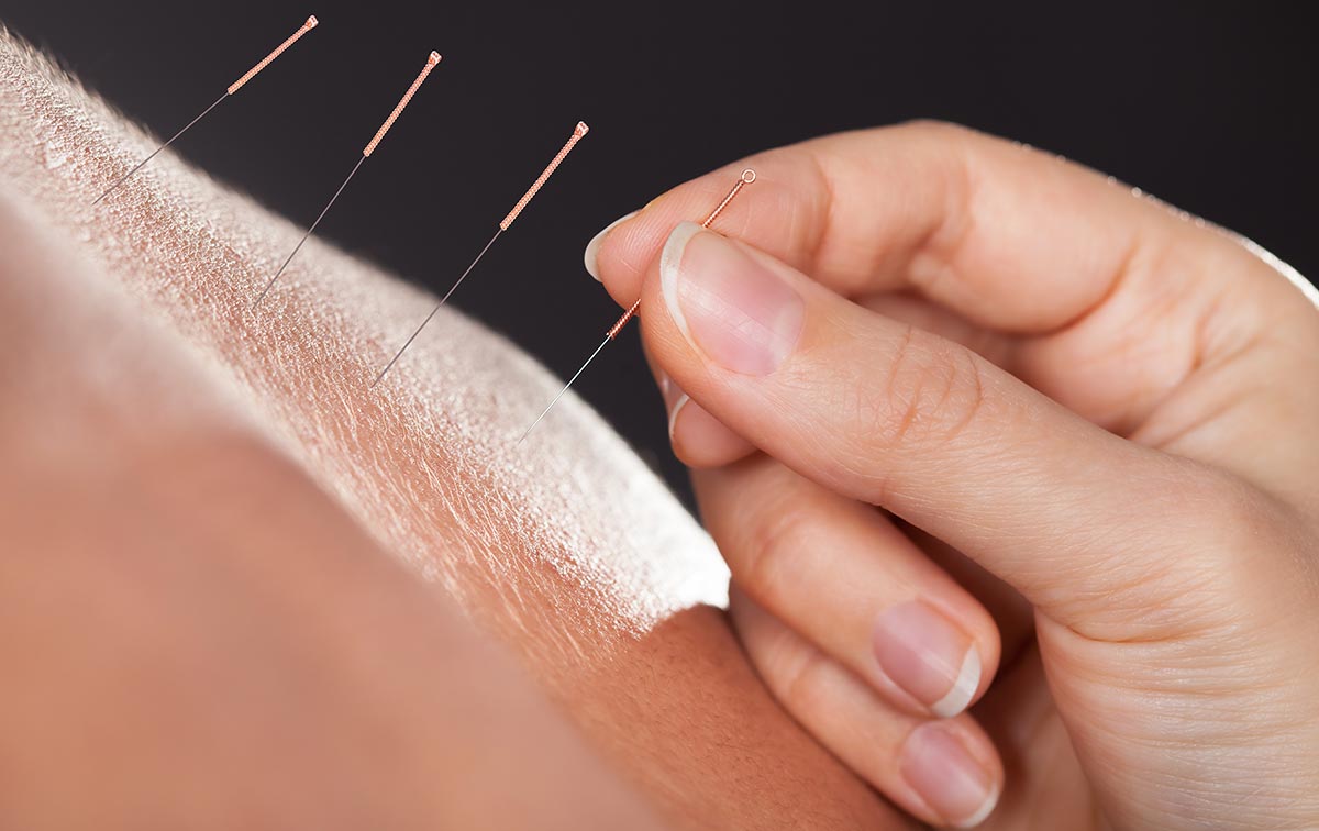 Acupuncture